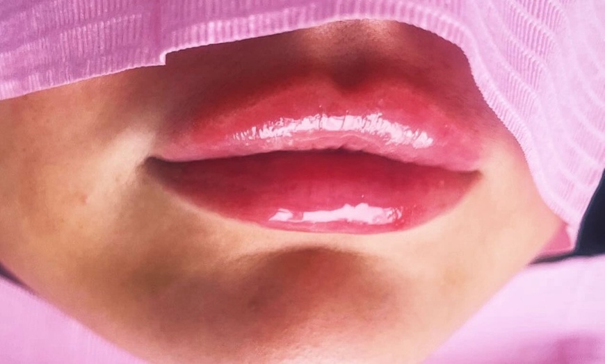 Image 1: Enhance Your Lips with 0.5ml or 1ml Lip Filler with Consultation