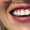 Image 1: Up to 50% Off on Teeth Whitening at Evolve Beauty Bar