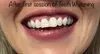 Up to 48% Off on Teeth Whitening at Evolve Beauty Bar