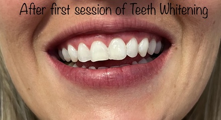 One Teeth Whitening Treatment - Evolve Beauty Bar