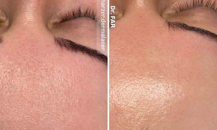 After Holiday Glow – 45 Min.: Tiefenwirksame Enzym-Hauterneuerung & Serum-Therapie für 1 Person - Harzer DermaLaser | Dr.FAR LaserLounge