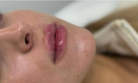 0.5ml dermal filler - Tm beauty