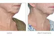 RF Skin-Tightening (Face/Neck/Décolletage) or RF Body-Contouring & Cellulite Reduction (Up to 69% Off) - Second Medium