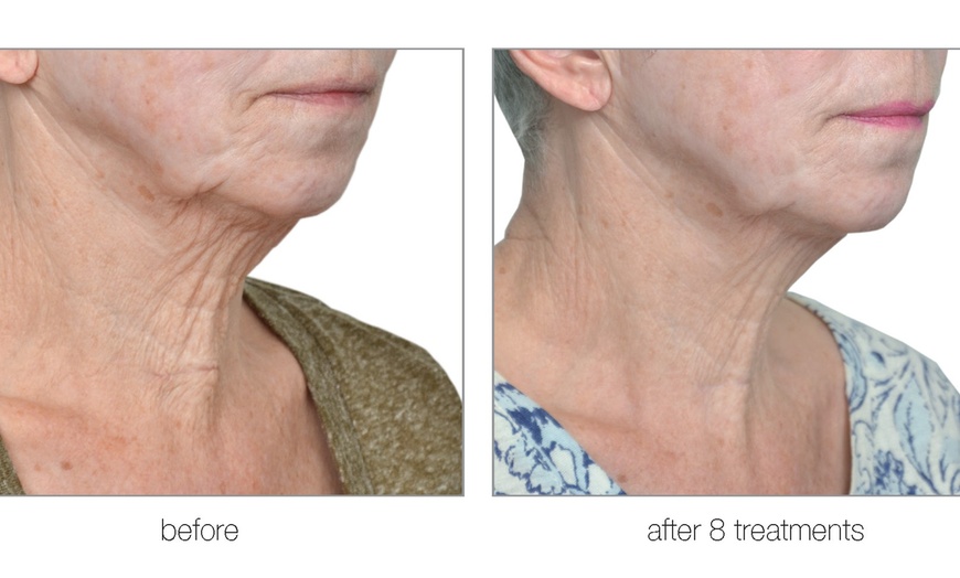 Image 2: RF Skin-Tightening (Face/Neck/Décolletage) or RF Body-Contouring & Cellulite Reduction (Up to 69% Off)