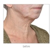 Image 2: RF Skin-Tightening (Face/Neck/Décolletage) or RF Body-Contouring & Cellulite Reduction (Up to 69% Off)