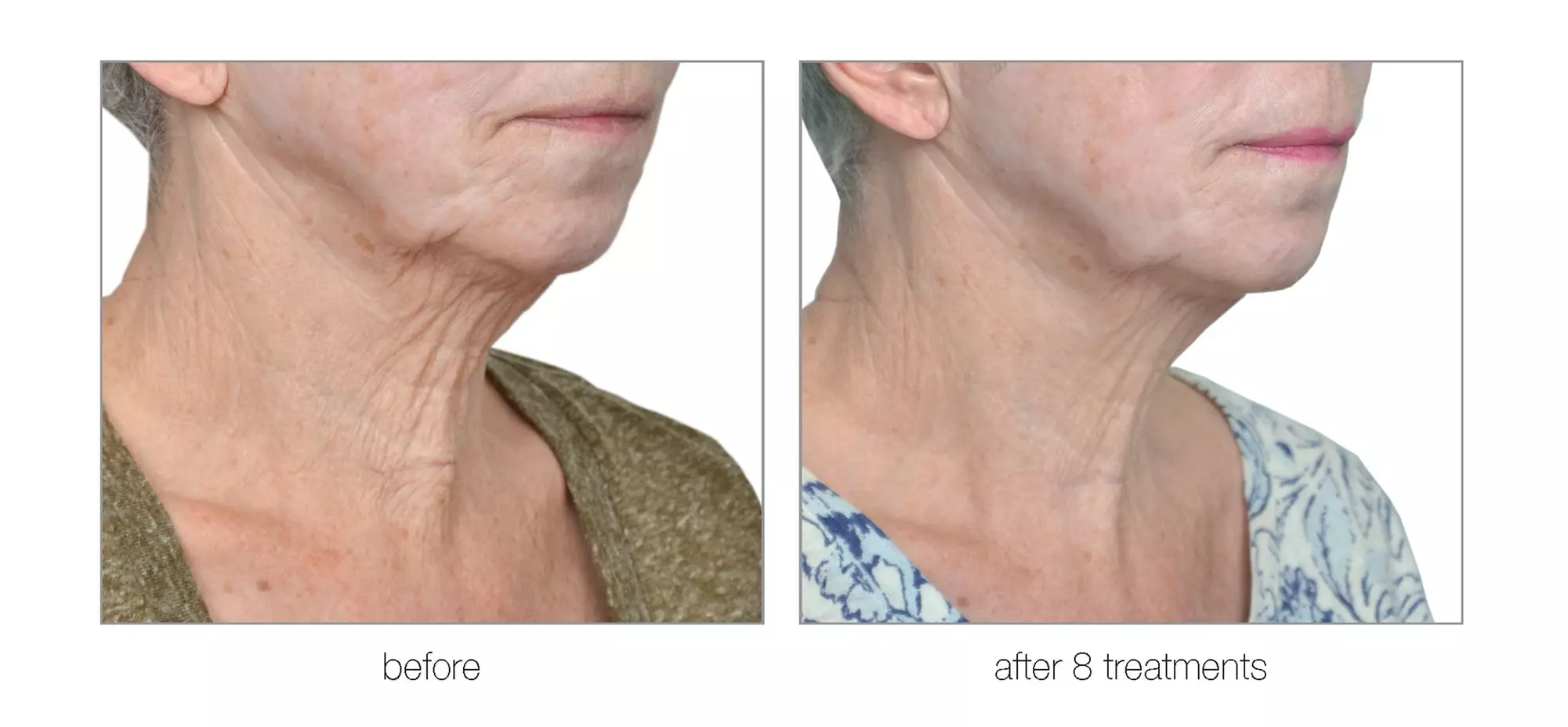 RF Skin-Tightening (Face/Neck/Décolletage) or RF Body-Contouring & Cellulite Reduction (Up to 69% Off)