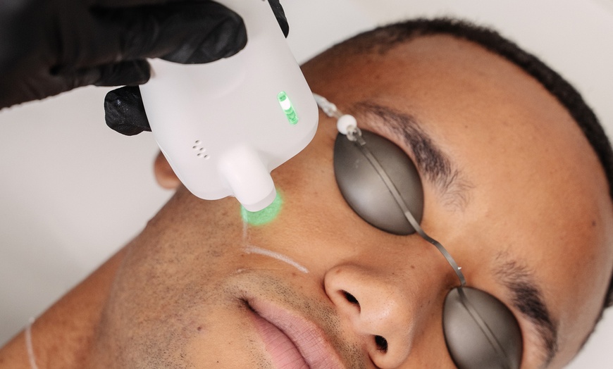 Image 8: Laser-Haarentfernung an 1 kleinen / großen Zone nach Wahl für 1 Person