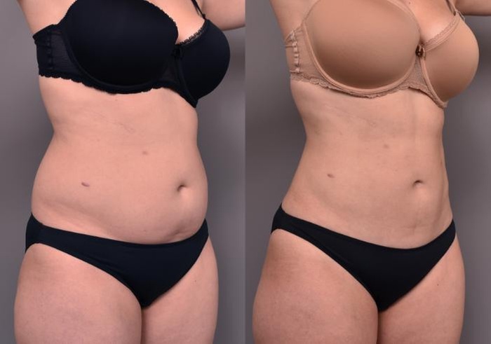 Lipo Fat Dissolving Injections for Chin, Back, Arms & Stomach 