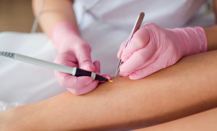 Image 2: Up to 30% Off on Electrolysis at Lasting Lines