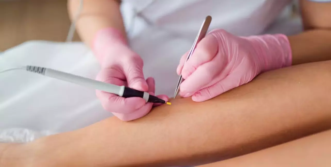 Up to 30% Off on Electrolysis at Lasting Lines