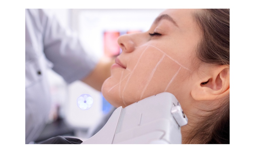 Image 1: HIFU Full Face w/ or w/o Neck, Double Chin or Jawline