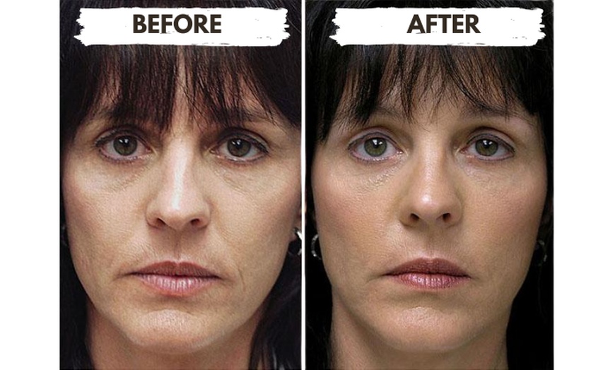 Image 4: 1/2, 1, 2, or 4 Vials of Sculptra Collagen-Stimulating Injectables