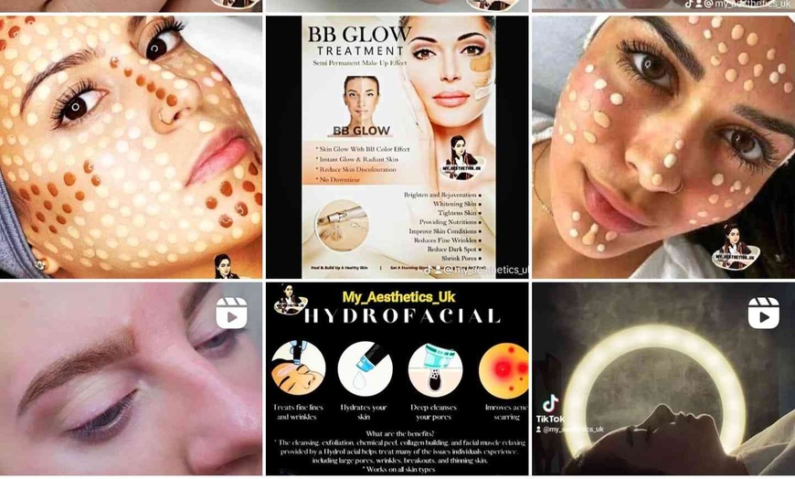 Image 5: Restore Your Radiance with 1 or 3 60-Min Luxury Microneedling Sessions