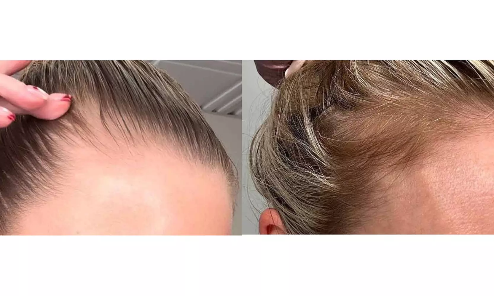 Up to 40% Off on Hair Restoration - Non-Surgical at Benefit Aesthetics