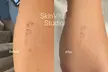 Up to 63% Off on Tattoo Removal at SkinVital Studio - Second Medium
