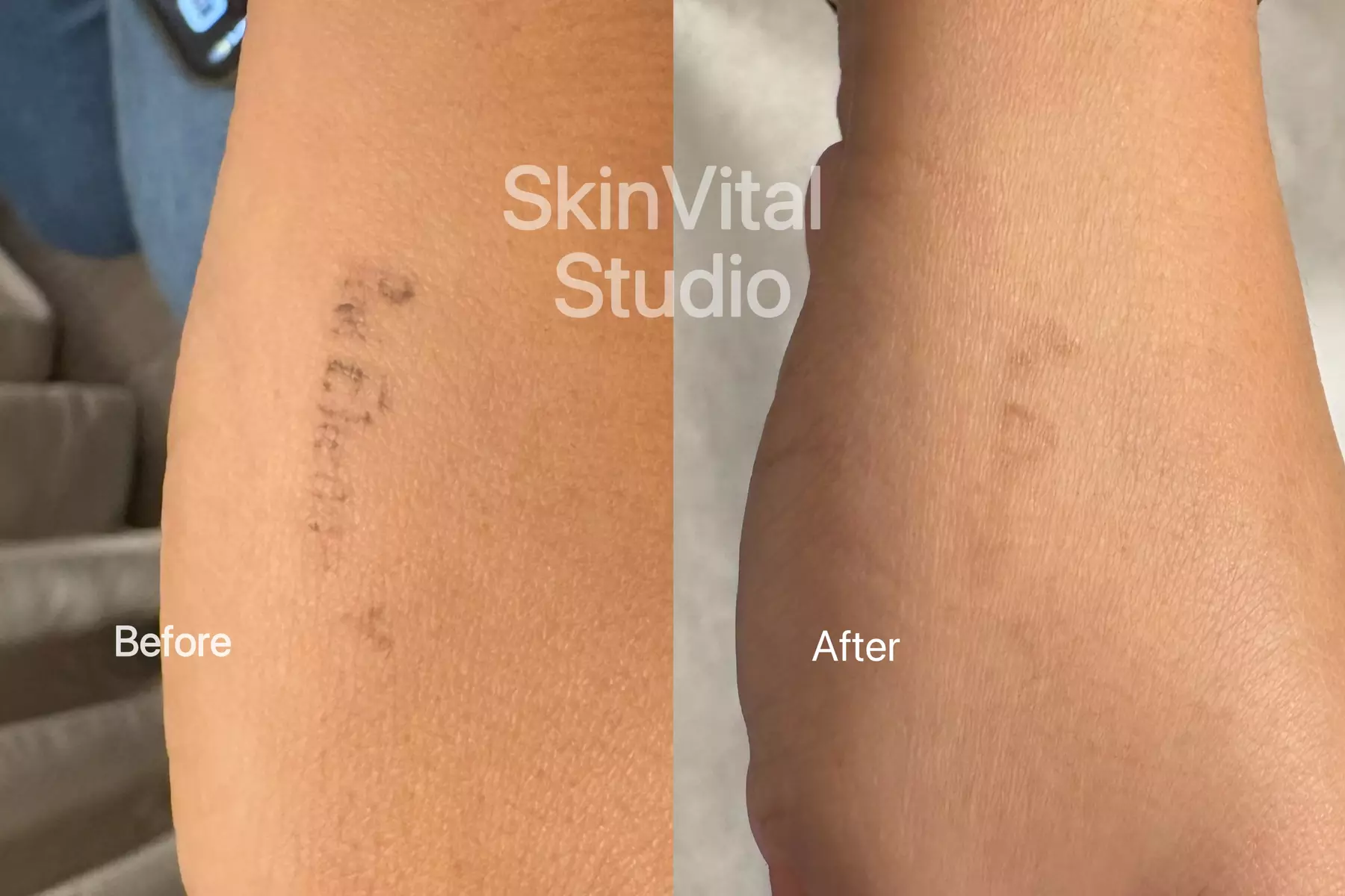 Up to 67% Off on Tattoo Removal at SkinVital Studio