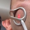 Image 1: 1 or 2 CO2 Laser Skin Treatments on Eyelids, Face, Neck or Acne Scar