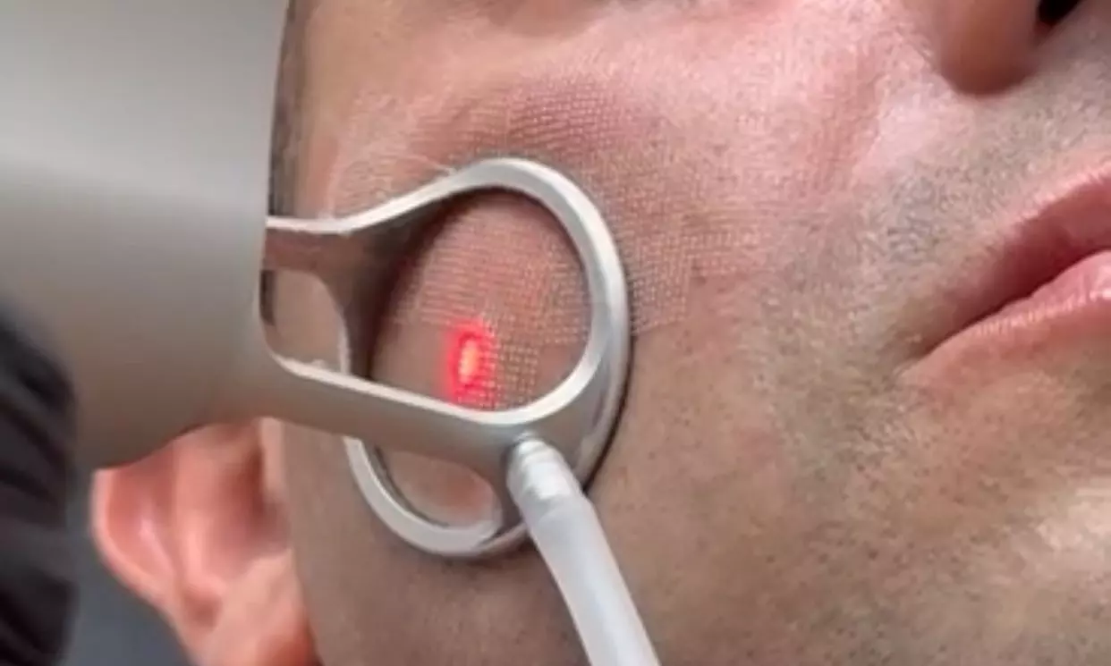 1 or 2 CO2 Laser Skin Treatments on Eyelids, Face, Neck or Acne Scar