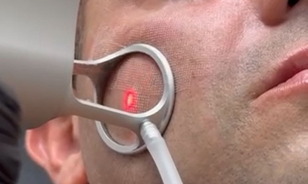 One CO2 Laser Skin Treatment (Eyelids) - Lov Med Spa - Miami