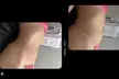 Targeted Fat Reduction – Non-Invasive Laser Lipo Session (Up to 50% Off) at Brilluxe Med Spa - Second Medium