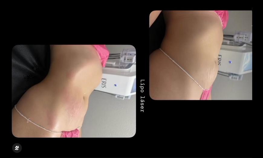 Image 5: Targeted Fat Reduction – Non-Invasive Laser Lipo Session