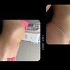Image 5: Targeted Fat Reduction – Non-Invasive Laser Lipo Session