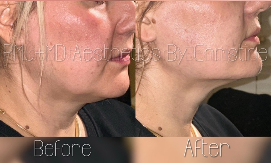 Image 7: Up to 43% Off on Injection-Organic Filler at PMU+MD AESTHETICS
