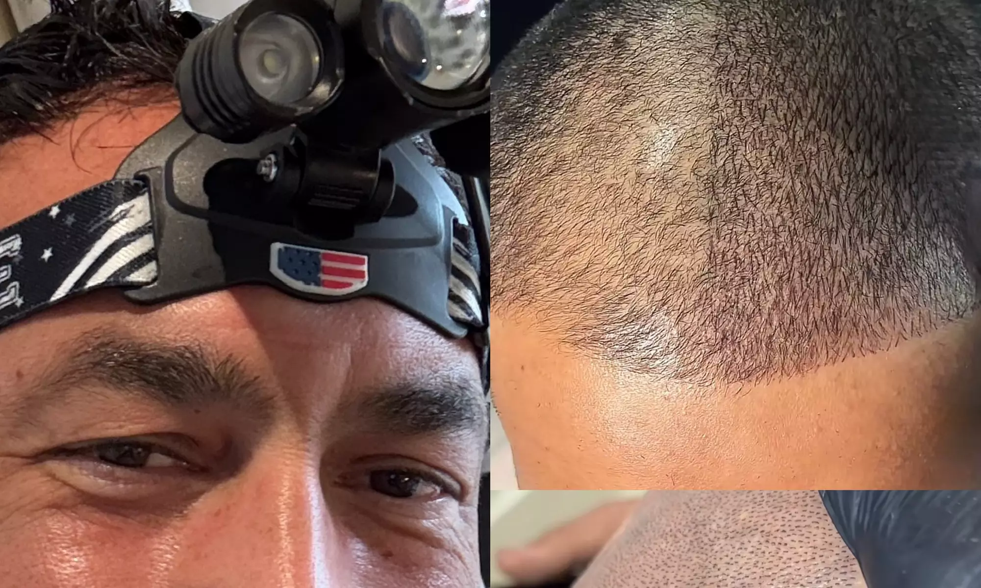 SMP Consultation w/ Hairline Focus, Density Boost for Hair Loss w/Care