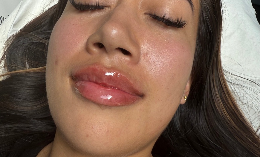 Image 5: Up to 54% Off on Injection - Dermal Filler at Perfection Clinic