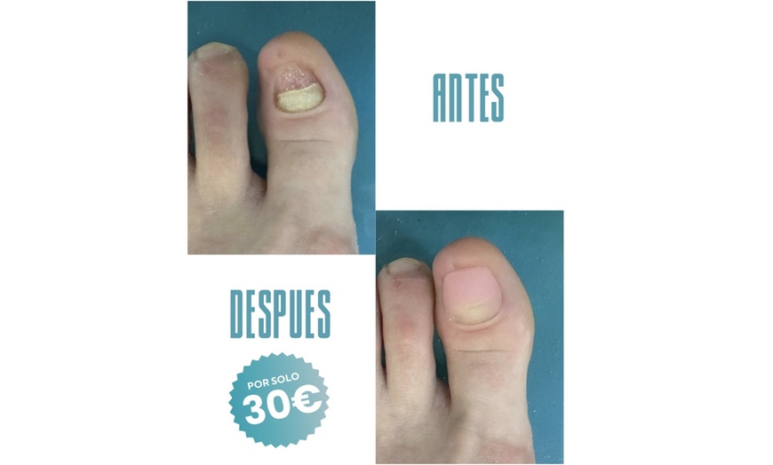 Image 4: Hasta 40% de dto. en Podólogo en Podoalegre Clínica Podológica