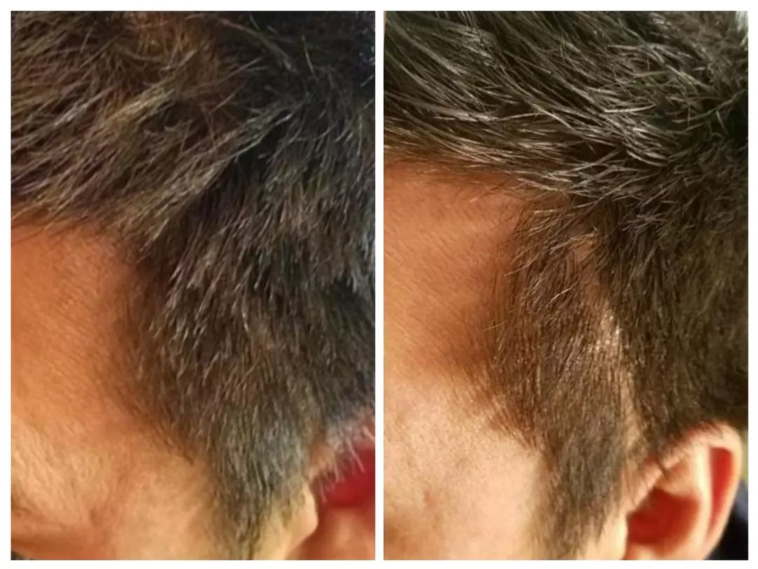 Up to 50% Off on Men and Women's Scalp Micropigmentation
