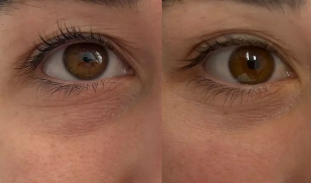 Rejuran Eye Skin Booster for Under-Eye Rejuvenation