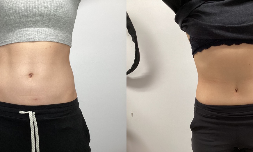 Image 6: Ultrasonic Fat Reduction at Ethereal Rejuvenation Clinic