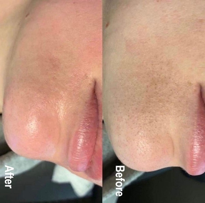 Up to 42% Off on HydraFacial at Aesthetics Care Med Spa