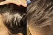 Up to 50% Off on Men and Women's Scalp Micropigmentation Treatments at Derma-Artistry Cosmetic Tattooing - Second Medium
