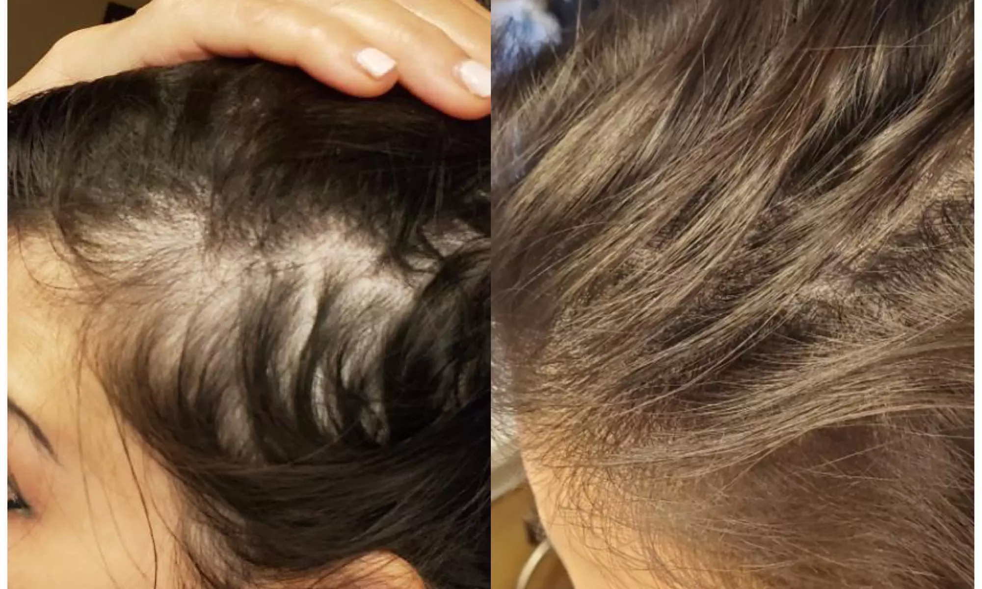 Up to 50% Off on Men and Women's Scalp Micropigmentation