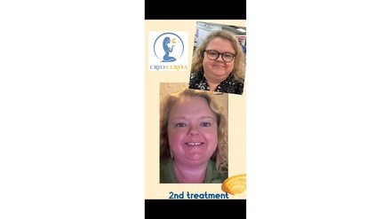 Non-Invasive Full Face and Neck HIFU Lift - Cryo Curves