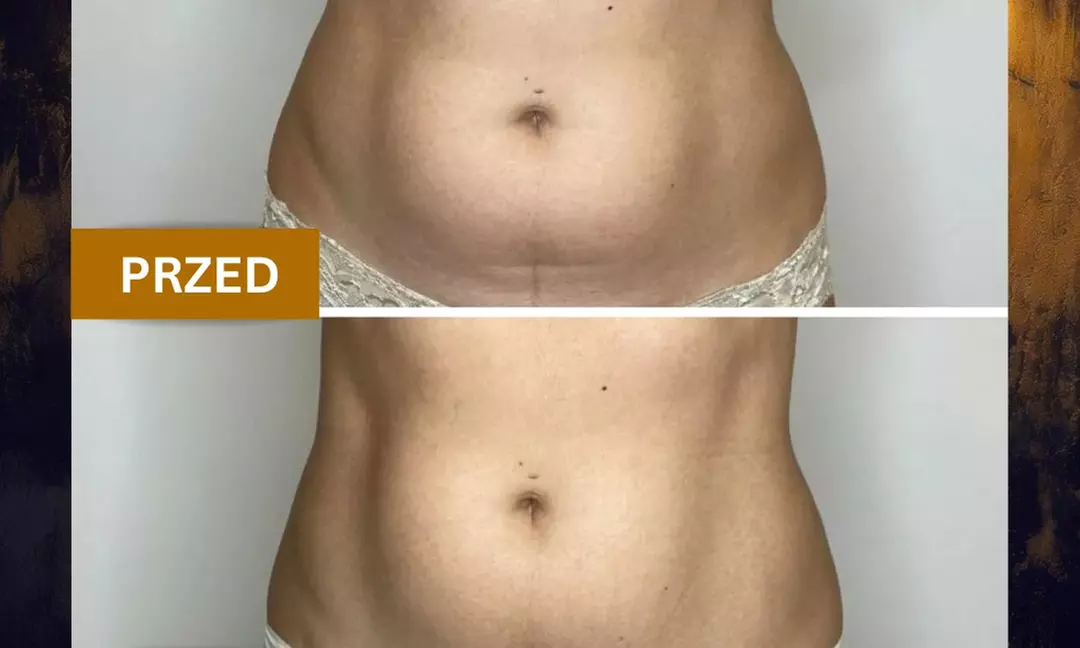 Modelowanie sylwetki i detoks: EMS, sauna IR, presoterapia (3 w 1)