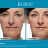 Image 1: Revitalize Skin's Youthful Glow with One Syringe of Radiesse Filler