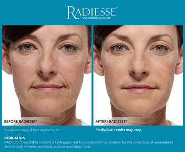 One Syringe of Radiesse (1.5mL) - Vivara Med Spa