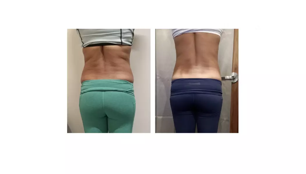 Up to 58% Off on Fat Reduction - Non-Branded at Your Sculpt Studio