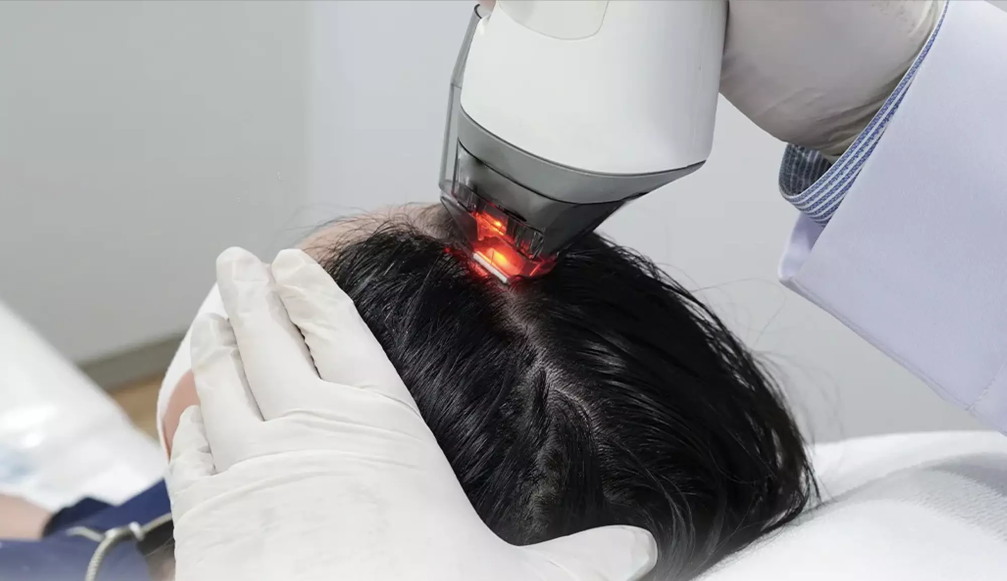 1, 2, or 3 Exosome Stem Cell or Advanced Hair Restoration Therapy with Thulium RF & Mesotherapy (Up to 40% Off) - Primary Image
