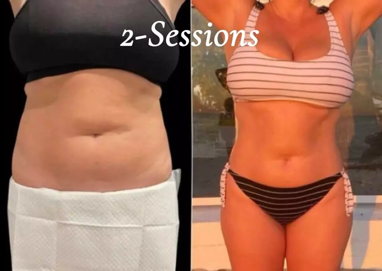 Up to 30% Off on Ultrasonic Fat Reduction at Dream beauty and med spa