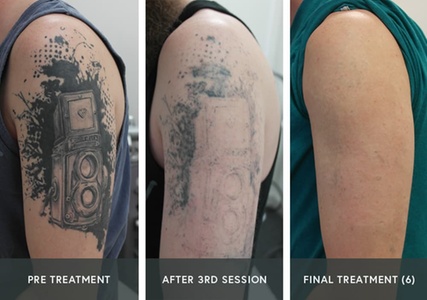 Three Laser Tattoo Removal Sessions on a Large Area - Amora Med Spa