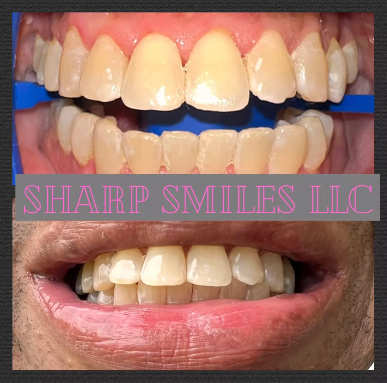 Brighten Your Smile With Teeth Whitening, Polishing & More