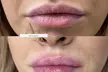 Enhance Your Look with Lip, Cheek or Chin Filler or a Russian Lip Flip Treatment (Up to 50% Off) - Second Medium