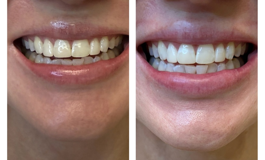 Image 3: Up to 79% Off on Teeth Whitening at B and K Smile Bright Studios