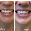 Image 3: Up to 79% Off on Teeth Whitening at B and K Smile Bright Studios