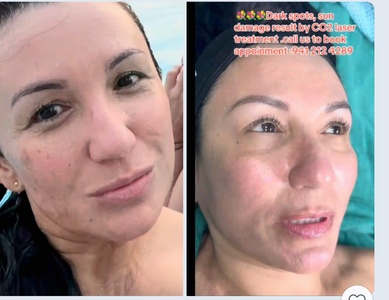 ONE Co2 laser treatment for eyelid - Hang's Spa