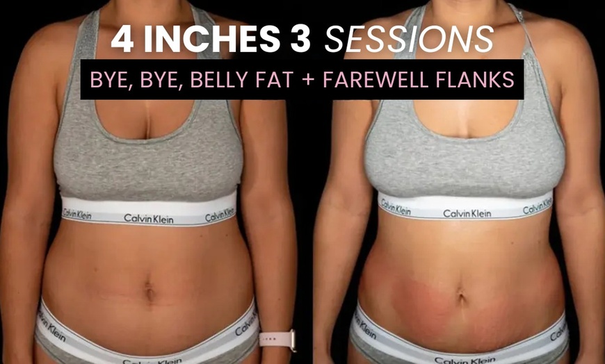 Image 3: Up to 79% Off on Lipo - Non-Invasive Laser-iLipo at Atlanta Body Sculpt